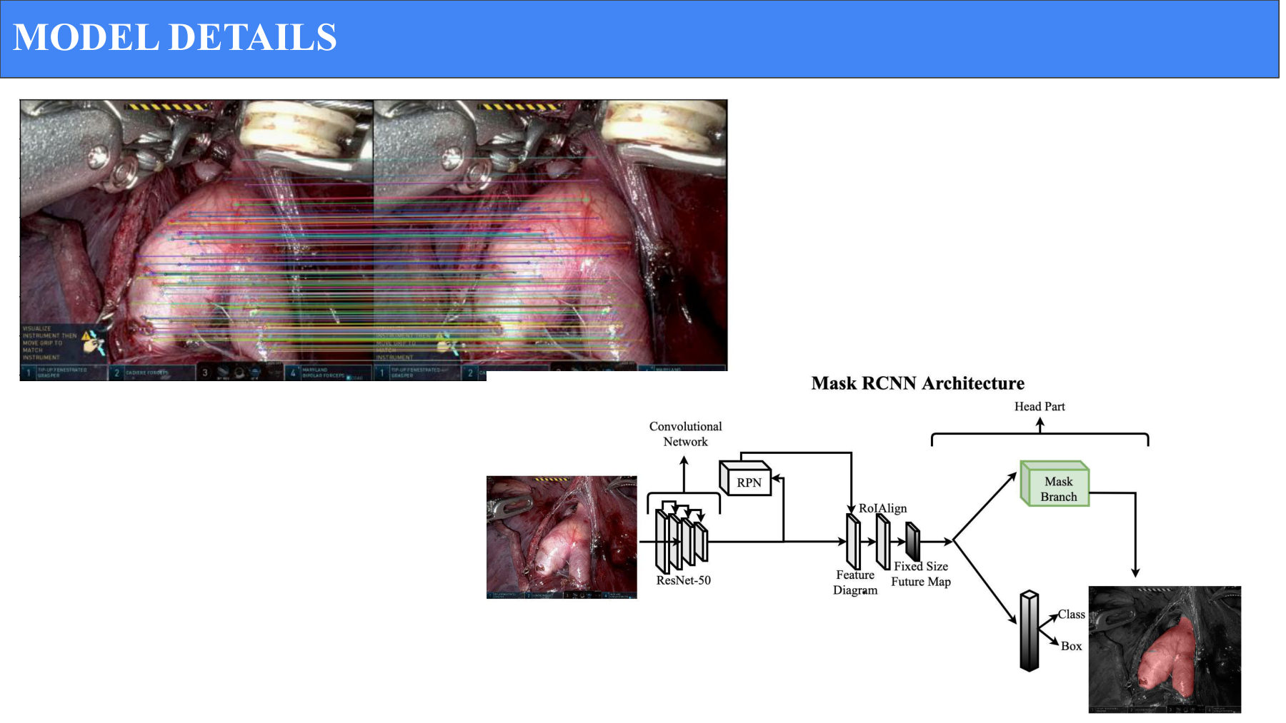 SIFT feature matching overlaid on actual surgical video frames